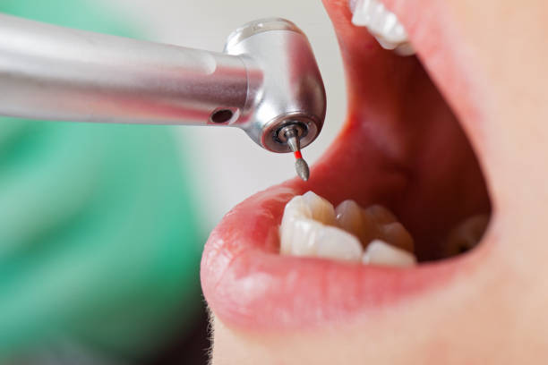 Best Emergency Dentist for Knocked-Out Tooth in Pine Castle, FL